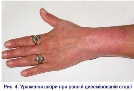 Інфекція потрапляє під час укусу кліща, кажуть лікарі з Тернополя, фото №3 на сайті 20minut.ua