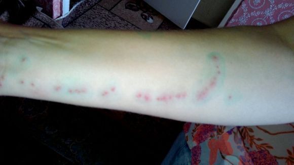 Клопи прокинулися і атакують оселі Козятинчан, фото №1 на сайті 20minut.ua