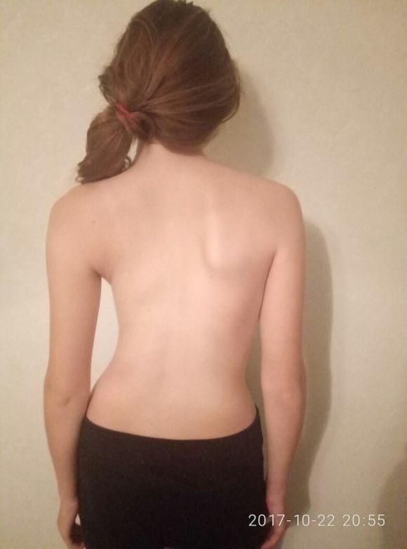 Батьки збирають гроші на лікування 14-річної доньки. Потрібно 90 тисяч гривень, фото №2 на сайті 20minut.ua