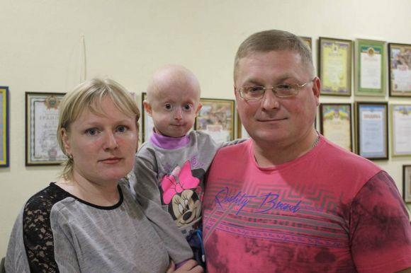 Надзвичайно рідкісну хворобу має маленька вінничанка Іринка. Потрібна допомога на сайті 20minut.ua Надзвичайно рідкісну хворобу має маленька вінничанка Іринка. Потрібна допомога, фото №1 на сайті 20minut.ua