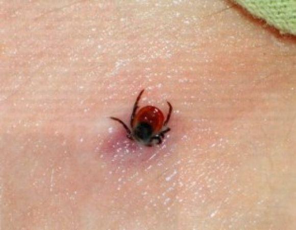 Новини Вінниці - фото з Сезон кліщів у розпалі. Як можна захиститись та що робити, якщо  вкусили? Сезон кліщів у розпалі. Як можна захиститись та що робити, якщо  вкусили?, фото №2 на сайті 20minut.ua