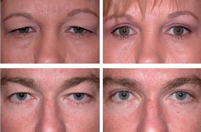 Новини Вінниці - фото з Робимо очі молодшими та здоровими Робимо очі молодшими та здоровими, фото №1 на сайті 20minut.ua