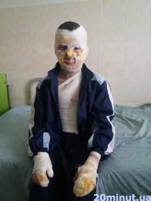 Новини Тернополя - фото з «Дякувати Богу, що все так минулося»: Руслан, який обгорів, коли спалахнула труна діда, уже бігає «Дякувати Богу, що все так минулося»: Руслан, який обгорів, коли спалахнула труна діда, уже бігає, фото №1 на сайті 20minut.ua