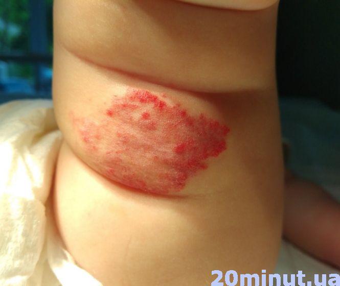 «Ми молилися, і донечка впоралась»: у чотиримісячної дівчинки з Тернополя видалили пухлину, фото №1 на сайті 20minut.ua