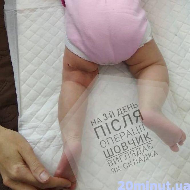 «Ми молилися, і донечка впоралась»: у чотиримісячної дівчинки з Тернополя видалили пухлину, фото №2 на сайті 20minut.ua