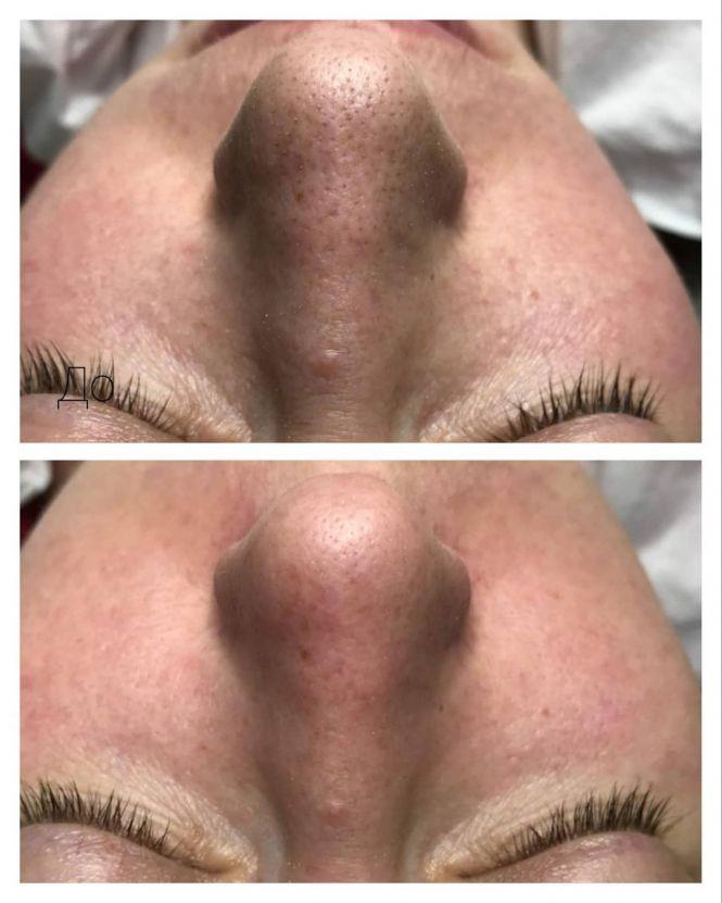 Новини Тернополя - фото з Чистка обличчя: коли, кому і для чого Чистка обличчя: коли, кому і для чого, фото №2 на сайті 20minut.ua