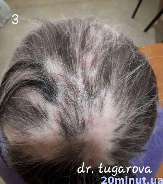 Унікальний випадок: жителька Тернопільщини 25 років ходила в перуці. Тепер розчісує своє волосся, фото №3 на сайті 20minut.ua