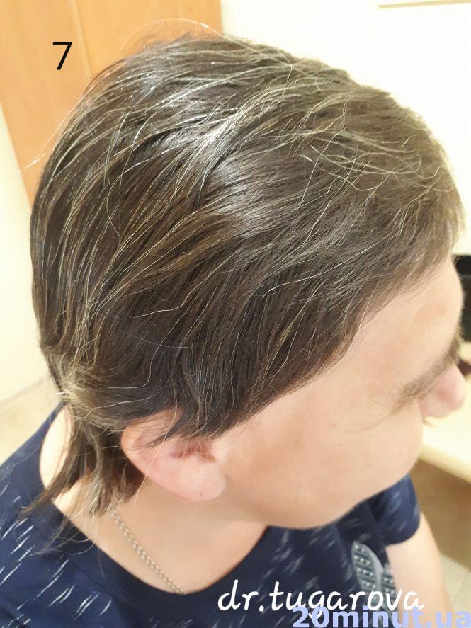 Унікальний випадок: жителька Тернопільщини 25 років ходила в перуці. Тепер розчісує своє волосся, фото №7 на сайті 20minut.ua