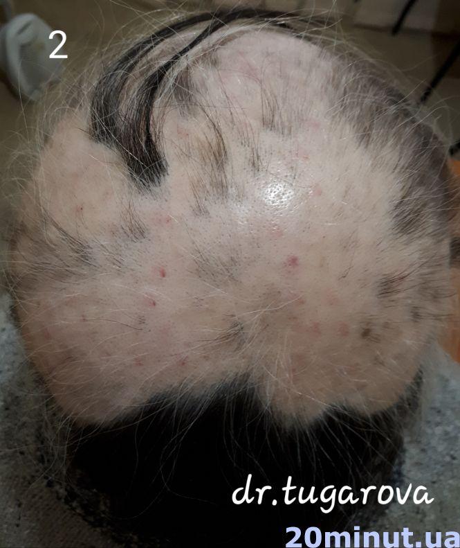 Унікальний випадок: жителька Тернопільщини 25 років ходила в перуці. Тепер розчісує своє волосся, фото №2 на сайті 20minut.ua