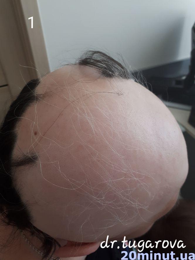 Унікальний випадок: жителька Тернопільщини 25 років ходила в перуці. Тепер розчісує своє волосся, фото №1 на сайті 20minut.ua