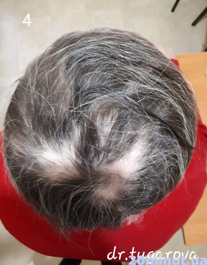 Унікальний випадок: жителька Тернопільщини 25 років ходила в перуці. Тепер розчісує своє волосся, фото №4 на сайті 20minut.ua