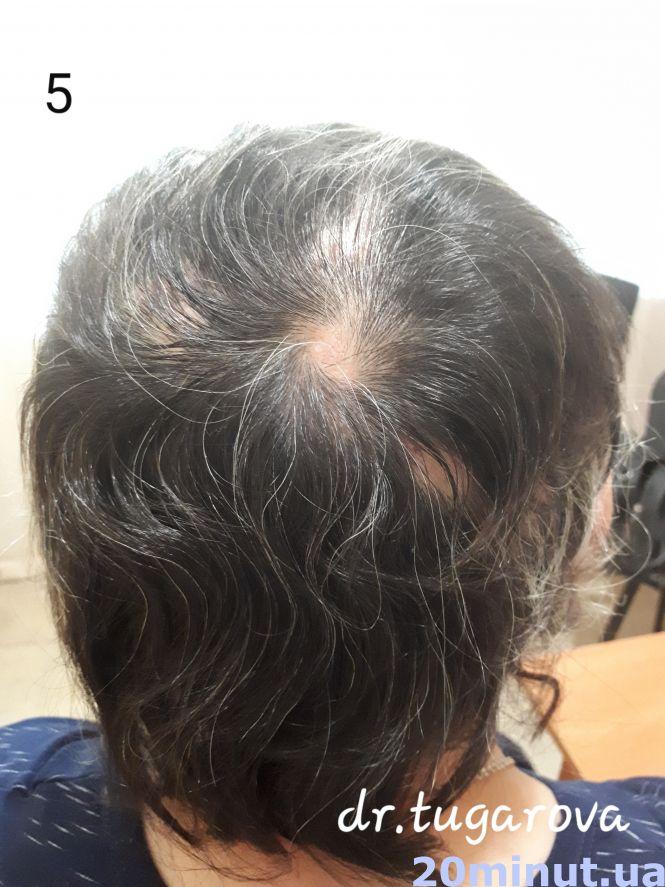 Унікальний випадок: жителька Тернопільщини 25 років ходила в перуці. Тепер розчісує своє волосся, фото №5 на сайті 20minut.ua