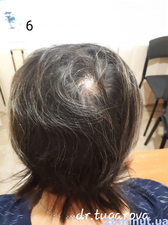 Унікальний випадок: жителька Тернопільщини 25 років ходила в перуці. Тепер розчісує своє волосся, фото №6 на сайті 20minut.ua