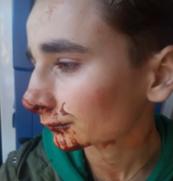 В Іллінцях сусіди побили 16-річного хлопця, який зробив їм зауваження на сайті 20minut.ua В Іллінцях сусіди побили 16-річного хлопця, який зробив їм зауваження, фото №1 на сайті 20minut.ua