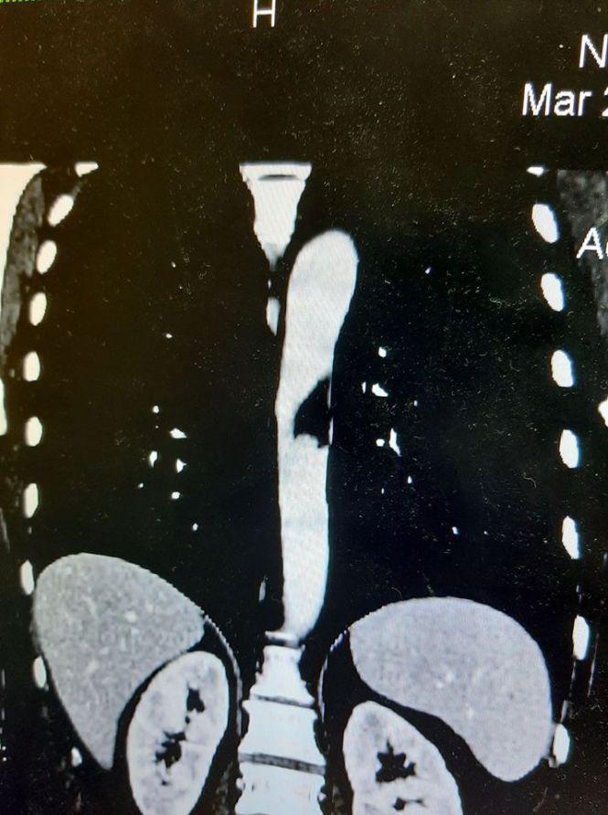 У тернопільській лікарні провели унікальну операцію та врятували життя жінці, фото №1 на сайті 20minut.ua