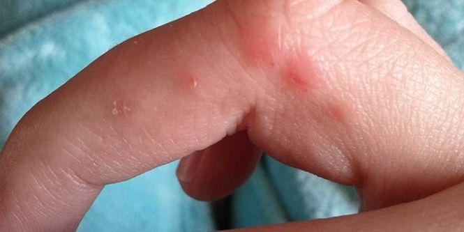 Вавка на губах і не тільки. Що робити з герпесами?, фото №1 на сайті 20minut.ua