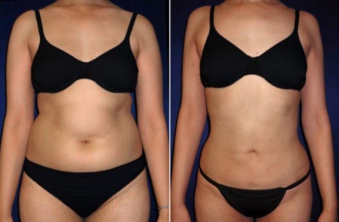 Новини Вінниці - фото з Пластичні операції у Вінниці: скільки коштує зробити груди, ніс і повіки? Пластичні операції у Вінниці: скільки коштує зробити груди, ніс і повіки?, фото №6 на сайті 20minut.ua