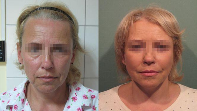 Новини Вінниці - фото з Пластичні операції у Вінниці: скільки коштує зробити груди, ніс і повіки? Пластичні операції у Вінниці: скільки коштує зробити груди, ніс і повіки?, фото №4 на сайті 20minut.ua