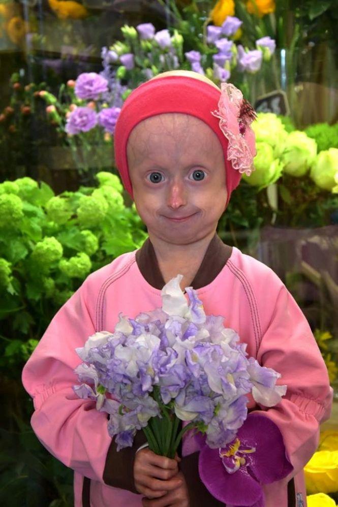 Новини Вінниці - фото з Маленьку вінничанку з синдромом передчасного старіння пролікують в США Маленьку вінничанку з синдромом передчасного старіння пролікують в США, фото №2 на сайті 20minut.ua