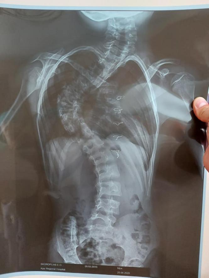 Новини Тернополя - фото з Едіку з Кременця, у якого померла мама та якого покинув батько, потрібна негайна операція. Допоможіть Світлина від Вячеслава Онишкевича.