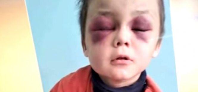 Днями хлопчик переніс клінічну смерть.  Який стан Іванка та Іванни після ДТП під Турбовом?, фото №2 на сайті 20minut.ua