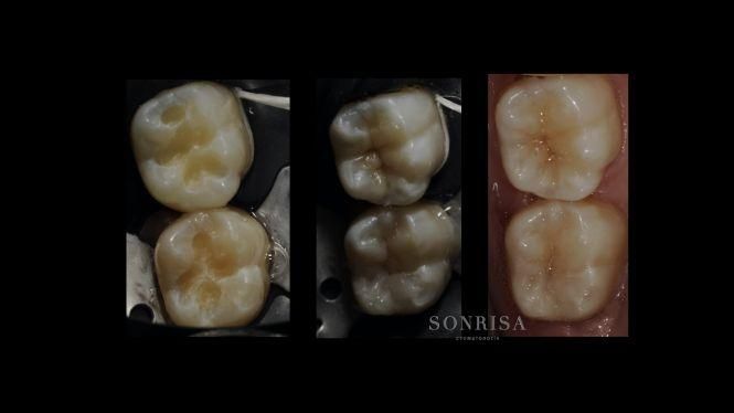 Новини Тернополя - фото з З турботою та гарантією на 10 років. Подбайте про свою красиву посмішку у клініці "Sonrisa" (новини компаній) З турботою та гарантією на 10 років. Подбайте про свою красиву посмішку у клініці "Sonrisa" (новини компаній), фото №3 на сайті 20minut.ua