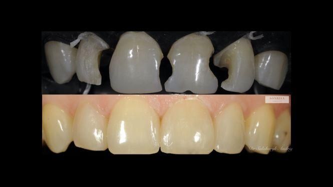 Новини Тернополя - фото з З турботою та гарантією на 10 років. Подбайте про свою красиву посмішку у клініці "Sonrisa" (новини компаній) З турботою та гарантією на 10 років. Подбайте про свою красиву посмішку у клініці "Sonrisa" (новини компаній), фото №1 на сайті 20minut.ua