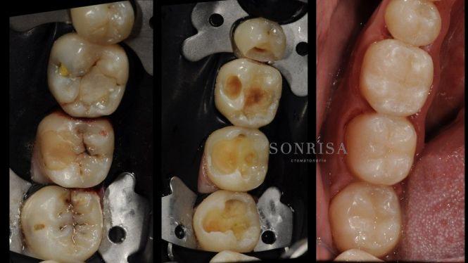 Новини Тернополя - фото з З турботою та гарантією на 10 років. Подбайте про свою красиву посмішку у клініці "Sonrisa" (новини компаній) З турботою та гарантією на 10 років. Подбайте про свою красиву посмішку у клініці "Sonrisa" (новини компаній), фото №4 на сайті 20minut.ua