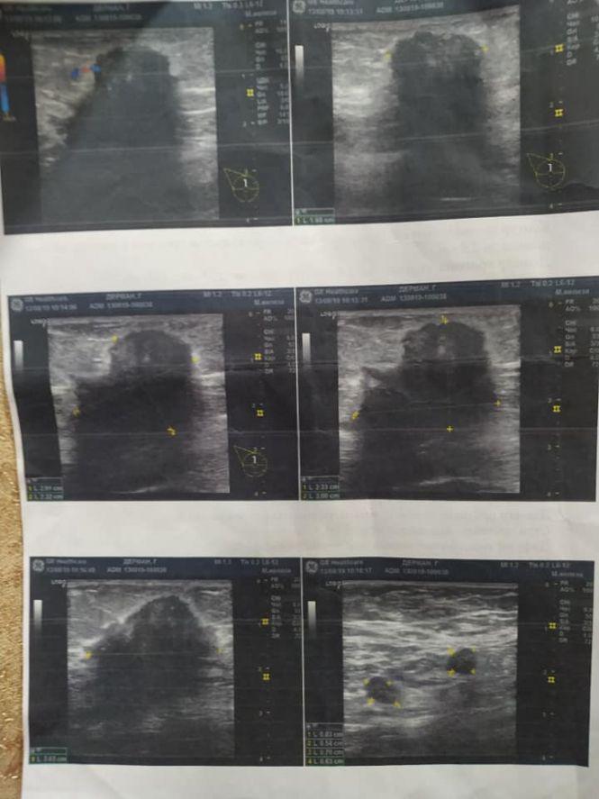 Допоможіть Галині Дерман жити без болю, фото №4 на сайті 20minut.ua