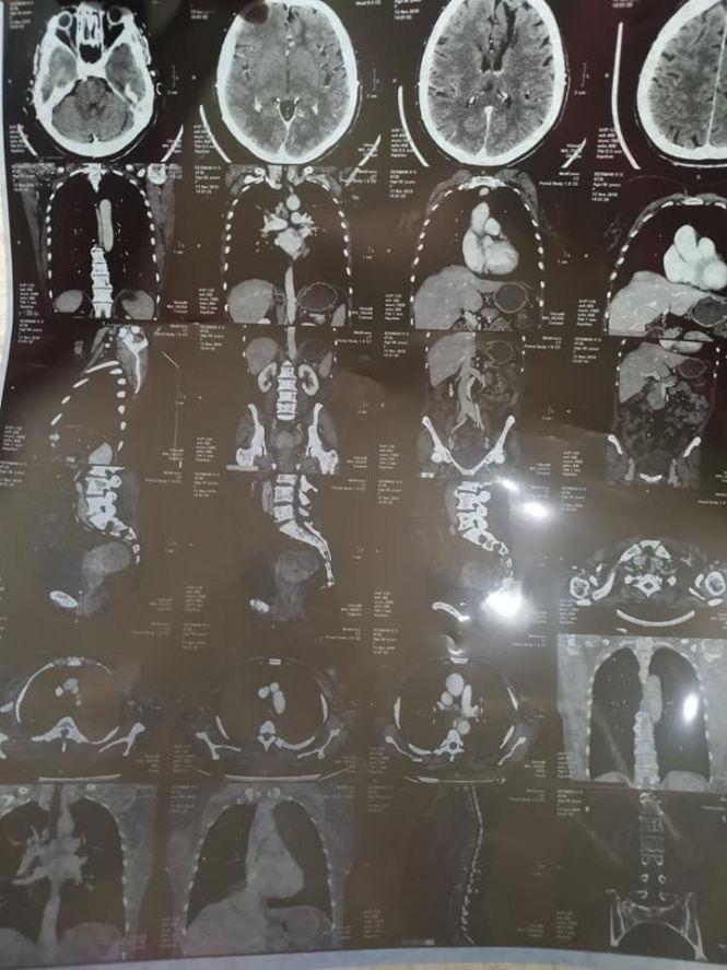 Допоможіть Галині Дерман жити без болю, фото №3 на сайті 20minut.ua