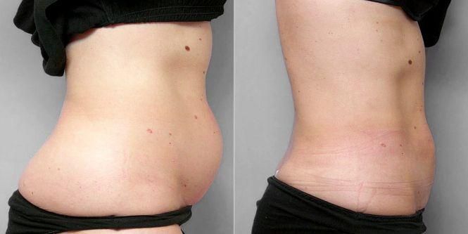 Новини Вінниці - фото з Корекція грудей, статевих органів, відновлення цноти. Які види тюнінгу найпопулярніші серед вінничан? Корекція грудей, статевих органів, відновлення цноти. Які види тюнінгу найпопулярніші серед вінничан?, фото №7 на сайті 20minut.ua