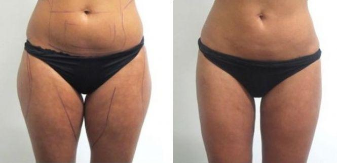 Новини Вінниці - фото з Корекція грудей, статевих органів, відновлення цноти. Які види тюнінгу найпопулярніші серед вінничан? Корекція грудей, статевих органів, відновлення цноти. Які види тюнінгу найпопулярніші серед вінничан?, фото №6 на сайті 20minut.ua