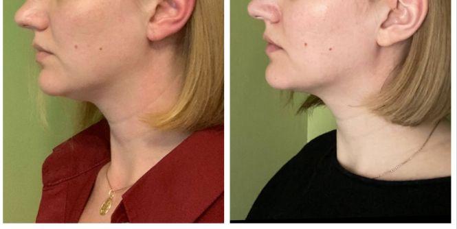 Фейсбілдінг VS ботокс? Про переваги гімнастики для обличчя розповідає тренер Вікторія Козак, фото №5 на сайті 20minut.ua