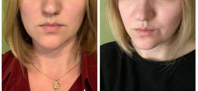 Фейсбілдінг VS ботокс? Про переваги гімнастики для обличчя розповідає тренер Вікторія Козак, фото №4 на сайті 20minut.ua