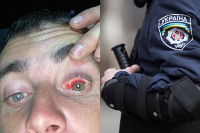 “Товкли, як м’яча”: Андрій з Хмельниччини стверджує, що його побили поліцейські