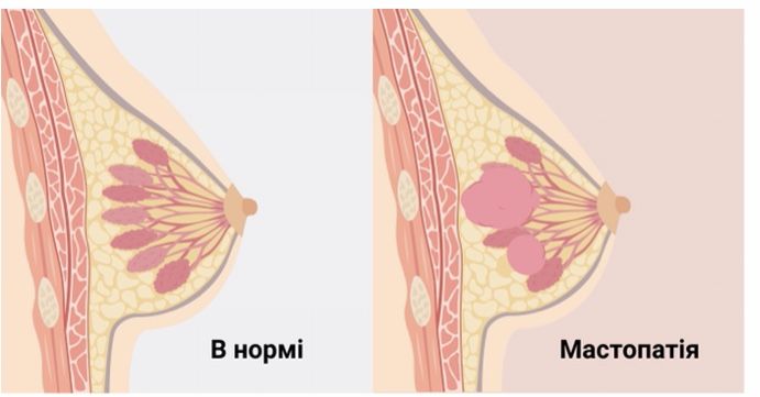 Новини Вінниці - фото з Мастопатія. Чи може це доброякісне новоутворення  стати раком молочної залози?