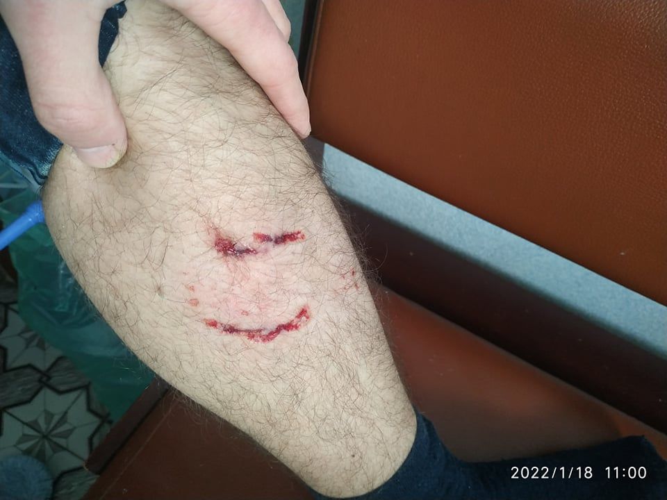 Новини Тернополя - фото з Тернополянина вкусив собака. Що робити у таких випадках – алгоритм дій