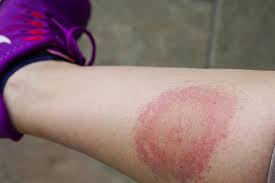 Новини Хмельницького - фото з На Хмельниччині зафіксували 95 випадків бореліозу: як вберегтися