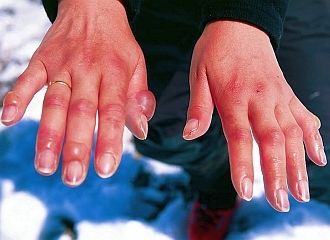 Новини Хмельницького - фото з Як запобігти переохолодженню та обмороженню взимку, — поради МОЗ