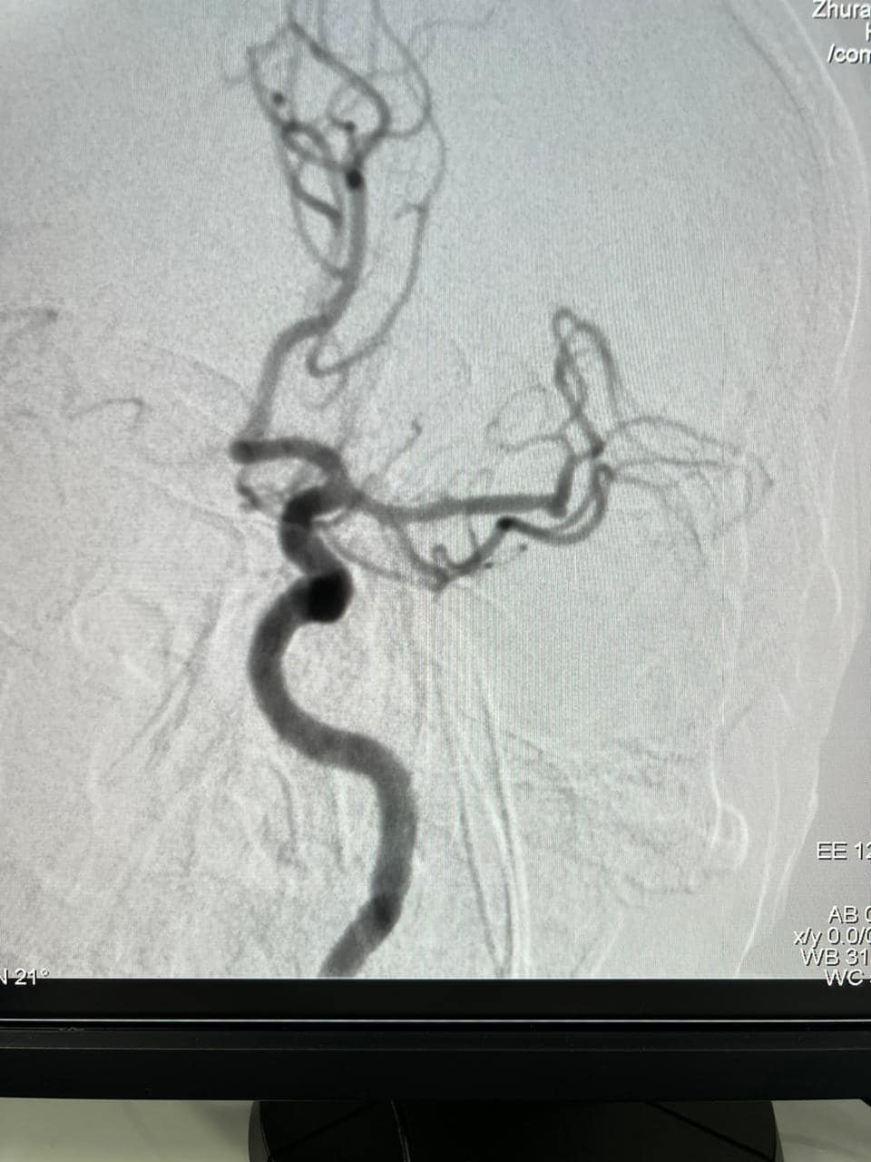 Новини Тернополя - фото з Вперше у Тернопільській області медики виконали складну операцію на судинах мозку
