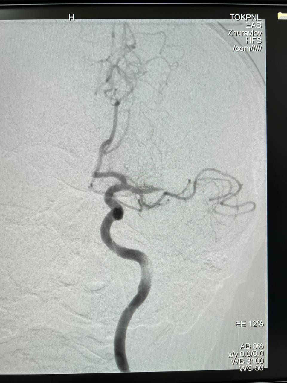 Новини Тернополя - фото з Вперше у Тернопільській області медики виконали складну операцію на судинах мозку
