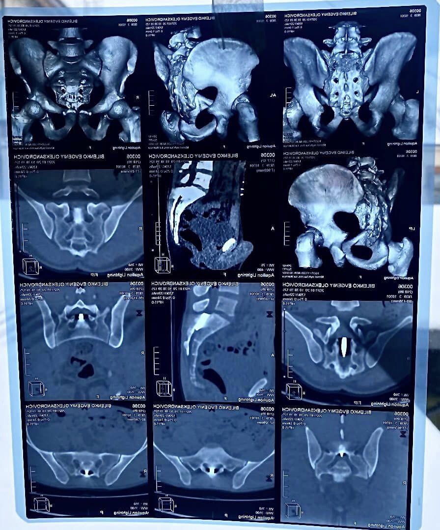 Новини Хмельницького - фото з Куля застрягла у попереку: в Хмельницькому військовому провели унікальну операцію