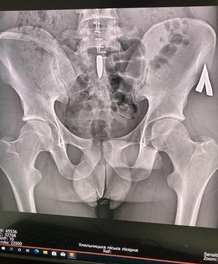 Новини Хмельницького - фото з Куля застрягла у попереку: в Хмельницькому військовому провели унікальну операцію