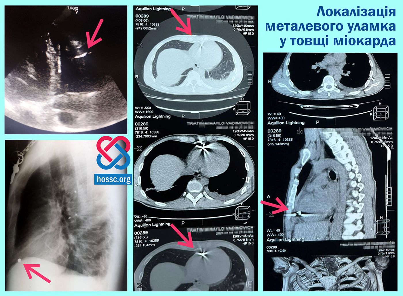 Новини Хмельницького - фото з Хмельницькі лікарі витягнули уламок міни із серця військового (ФОТО)