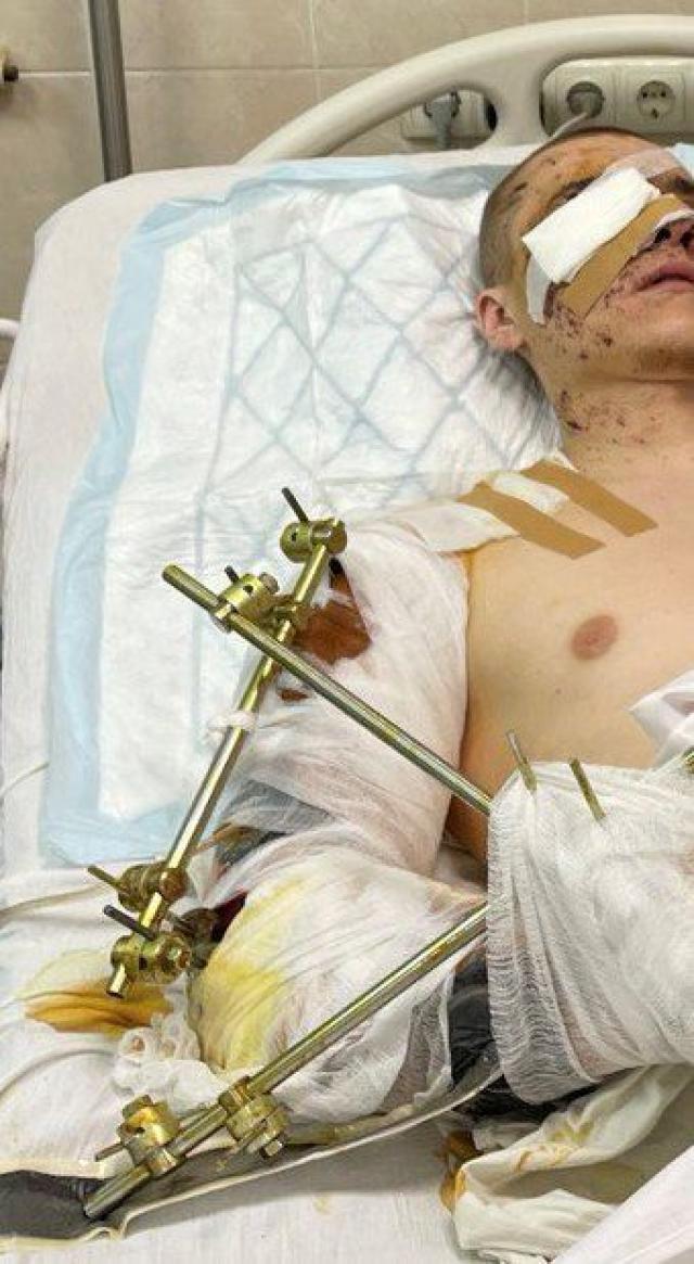 Новини Вінниці - фото з Навіть пов’язки не сховають болю… В лікарню Мечникова привезли Олександра з Вінниччини