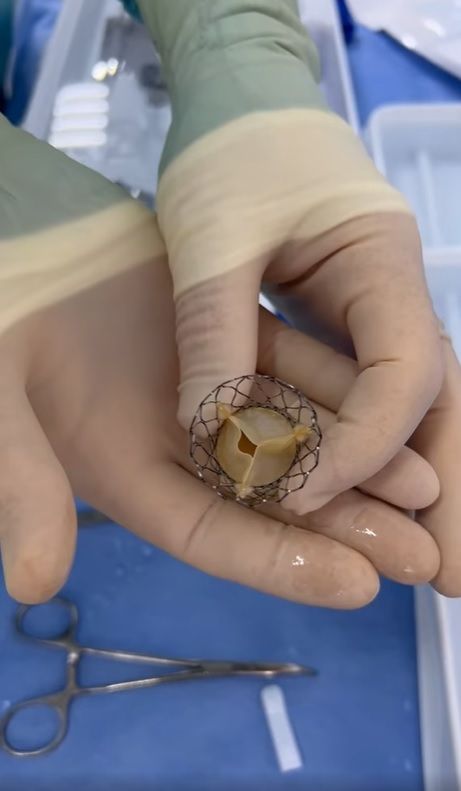 Новини Тернополя - фото з У Тернополі вперше в області замінили серцевий клапан без відкритої операції