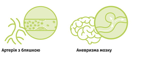 Новини Хмельницького - фото з Інсульт: стратегії порятунку від Spinex (новини компаній)