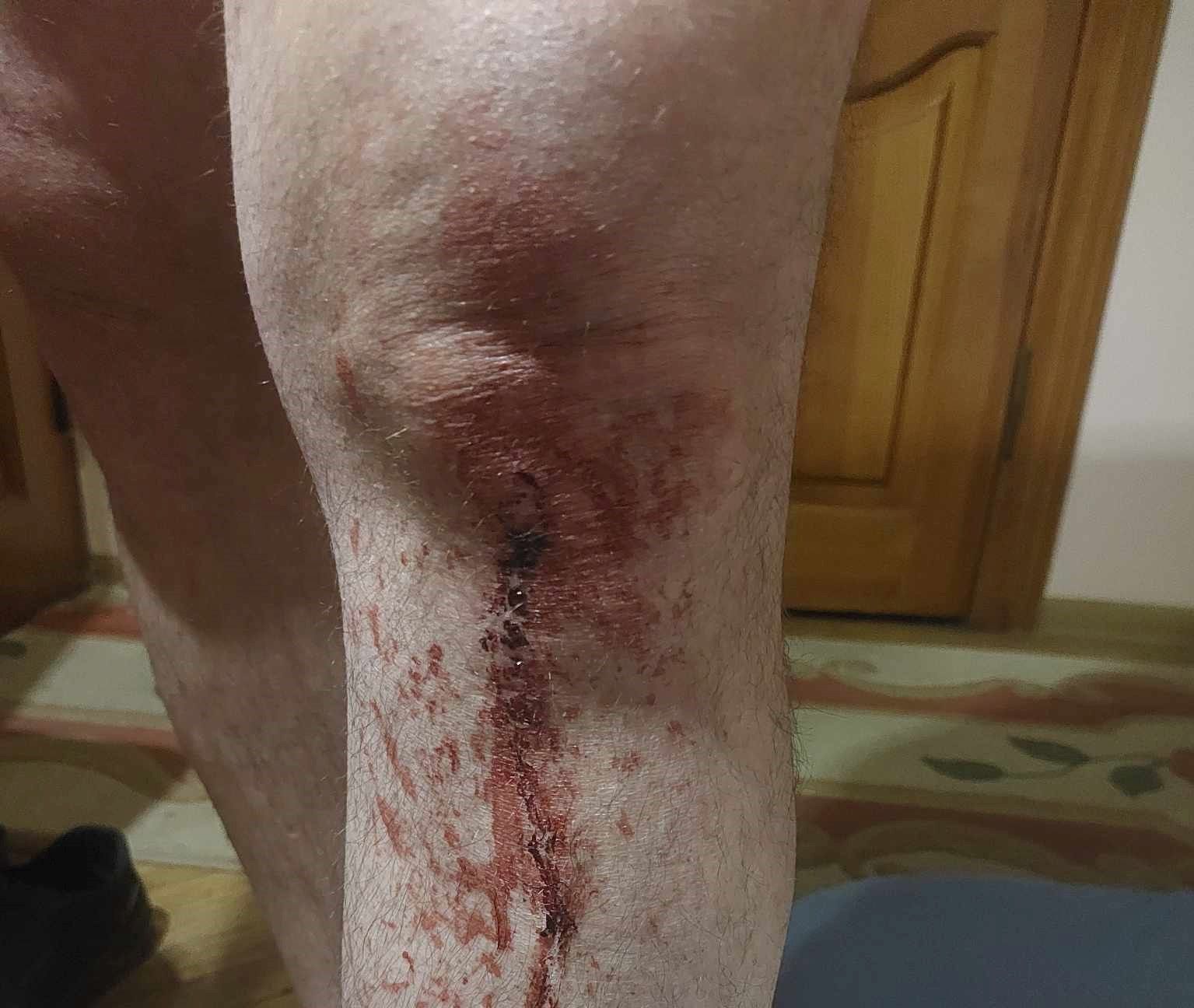 Новини Тернополя - фото з Врятувалися, бо впали на землю, але тіло у порізах від скла.  Як тернополяни пережили ракетний удар