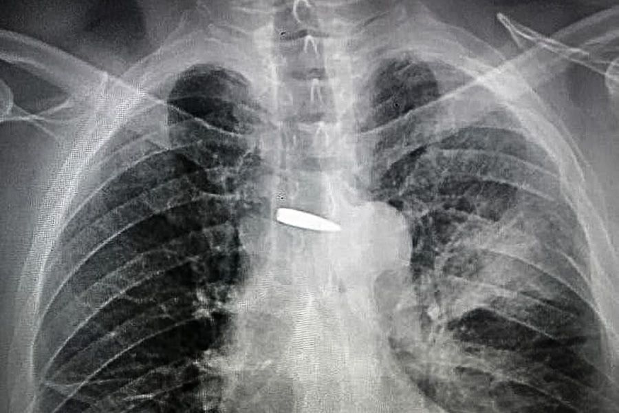 Новини Хмельницького - фото з Куля була біля серця: врятований хмельницькими лікарями військовий повернувся на фронт