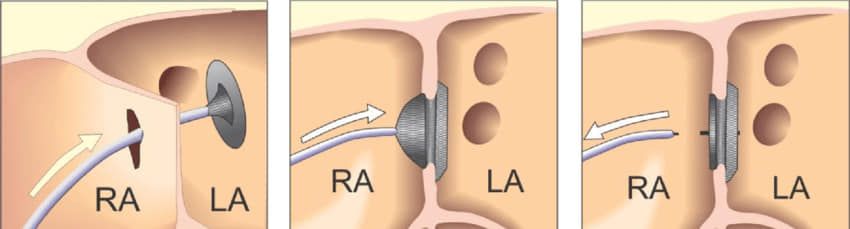 Новини Тернополя - фото з У Тернопількій обласній лікарні вперше ліквідували дефект у серці без розрізу